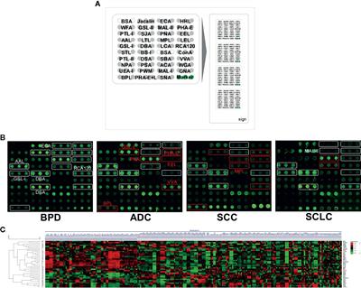 Protein Glycopatterns in Bronchoalveolar Lavage Fluid as Novel Potential Biomarkers for Diagnosis of Lung Cancer